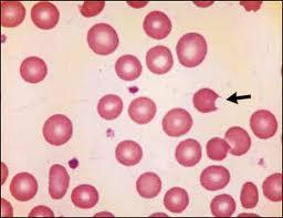 Bite Cell in G6PD deficiency